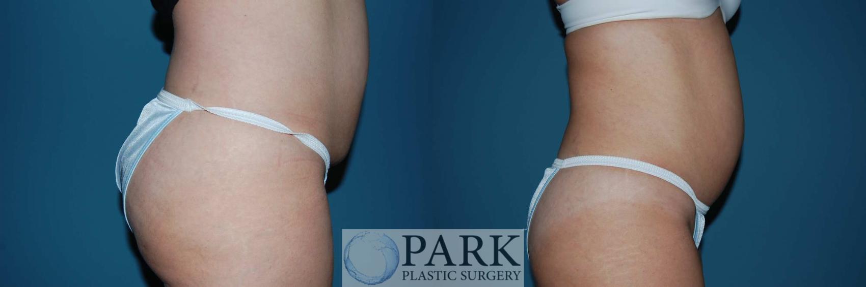 Before & After Liposuction Case 5 Right Side View in Rocky Mount & Greenville, NC