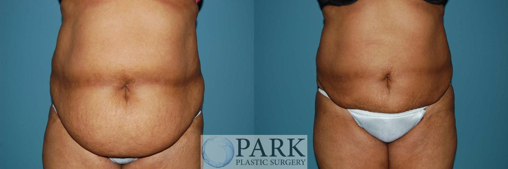 Before & After Liposuction Case 6 Front View in Rocky Mount, NC