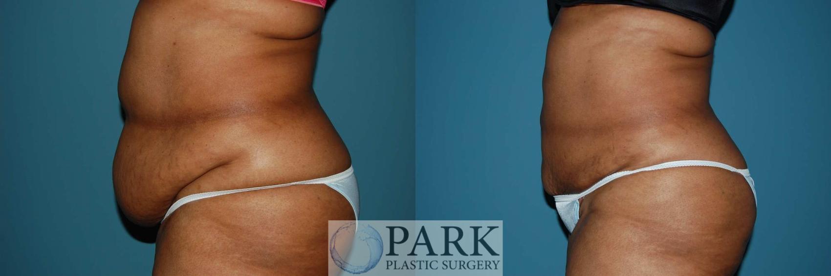 Before & After Liposuction Case 6 Left Side View in Rocky Mount & Greenville, NC