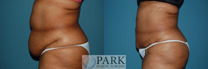 Before & After Liposuction Case 6 Left Side View in Rocky Mount, NC