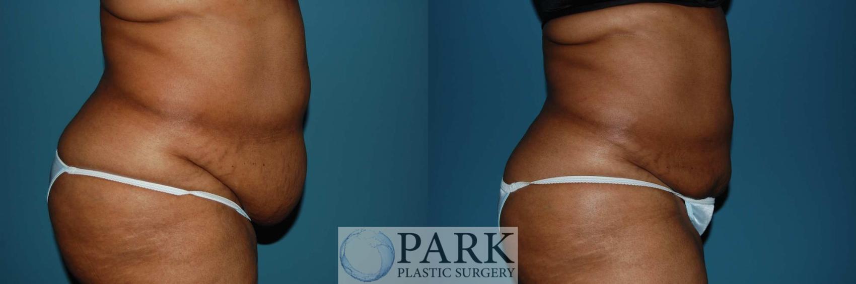 Before & After Liposuction Case 6 Right Side View in Rocky Mount & Greenville, NC