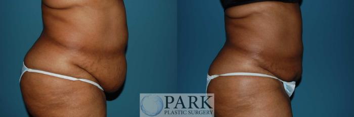 Before & After Liposuction Case 6 Right Side View in Rocky Mount, NC
