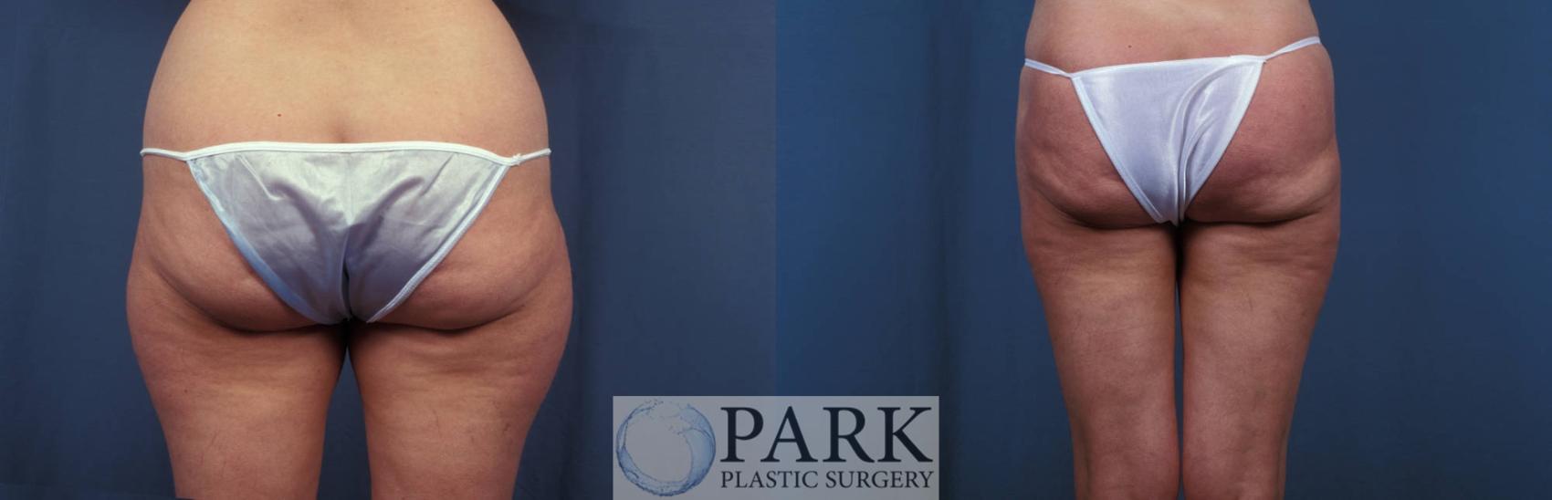 Before & After Liposuction Case 7 Back View in Rocky Mount & Greenville, NC