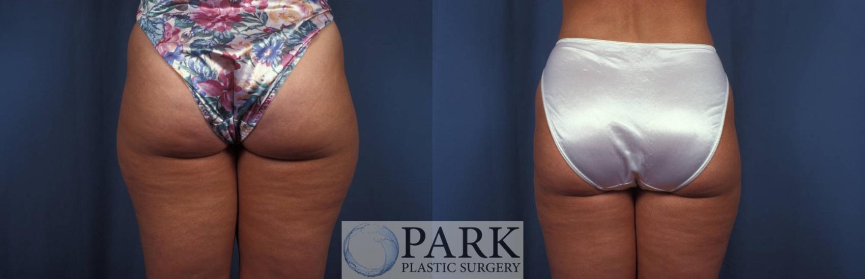 Before & After Liposuction Case 8 Back View in Rocky Mount & Greenville, NC
