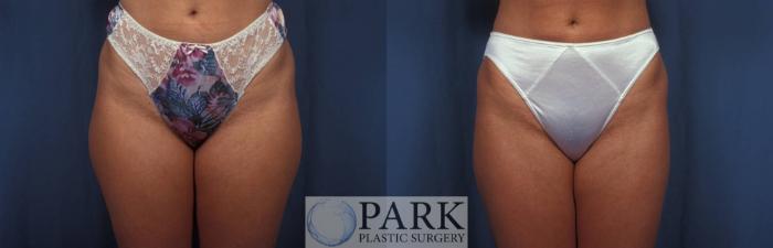Before & After Liposuction Case 8 Front View in Rocky Mount, NC