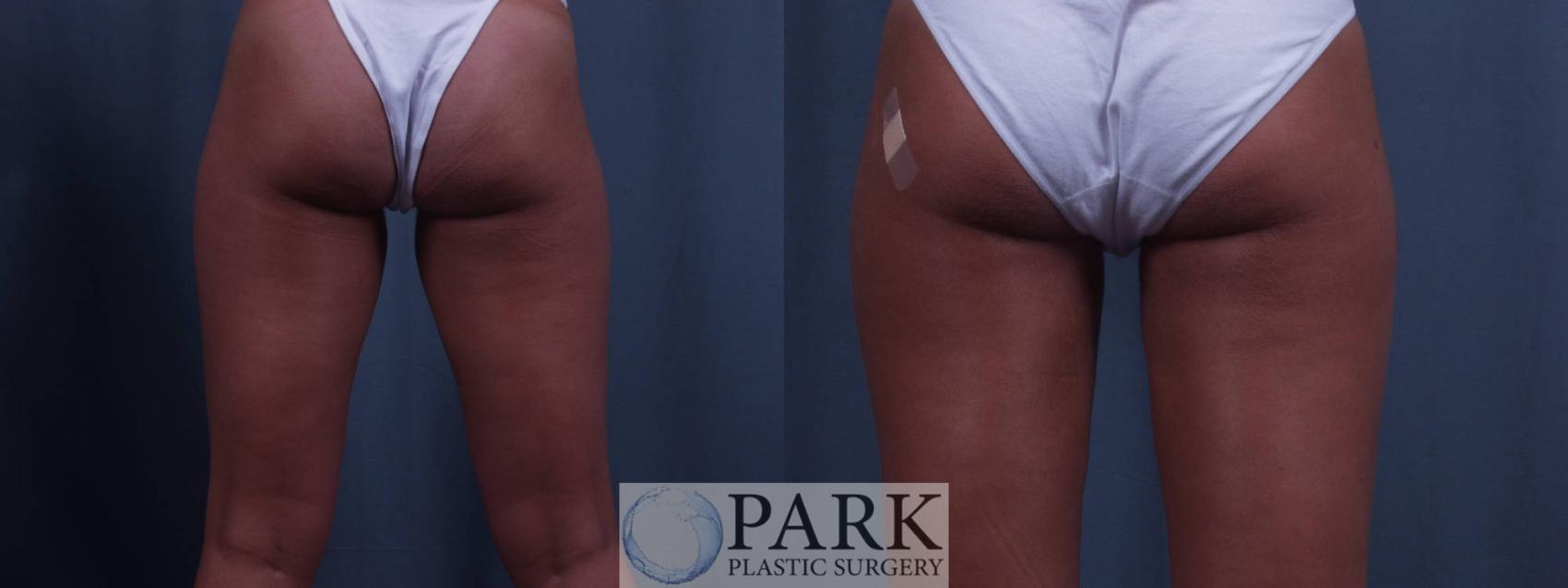Before & After Liposuction Case 9 Back View in Rocky Mount & Greenville, NC