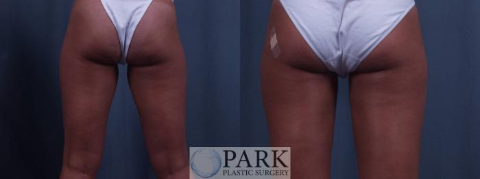 Before & After Liposuction Case 9 Back View in Rocky Mount, NC