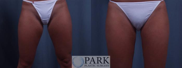 Before & After Liposuction Case 9 Front View in Rocky Mount, NC