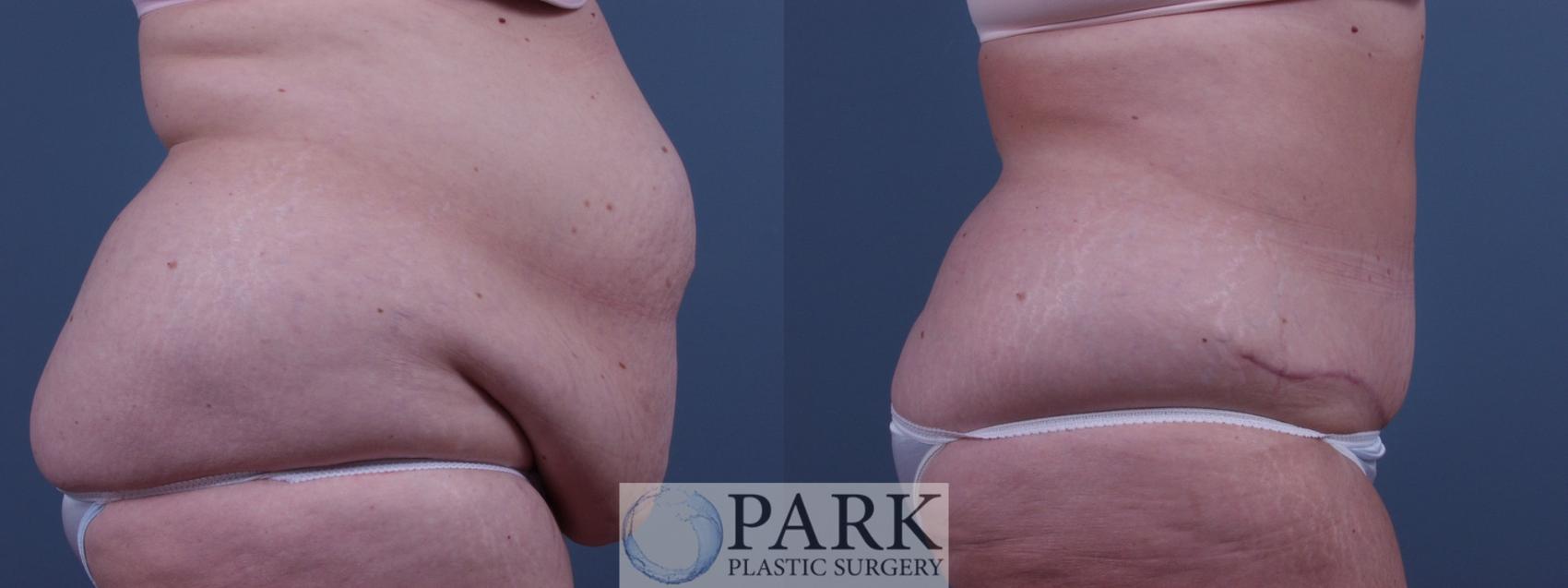 Before & After Tummy Tuck Case 33 Right Side View in Rocky Mount, NC