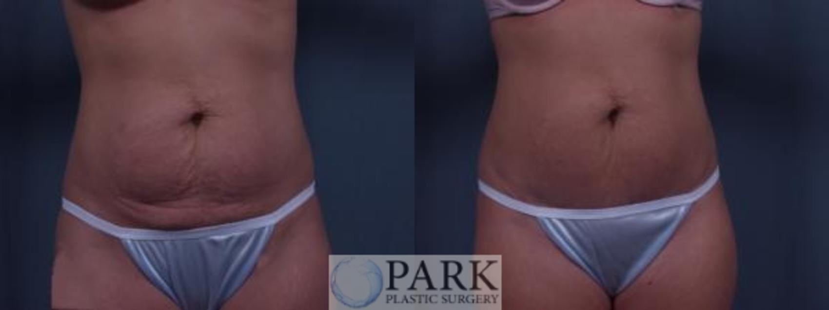 Before & After Tummy Tuck Case 34 Front View in Rocky Mount & Greenville, NC