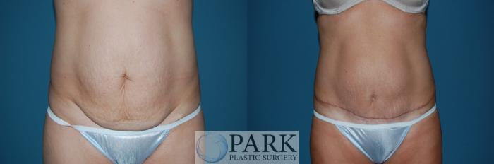 Before & After Tummy Tuck Case 36 Front View in Rocky Mount, NC