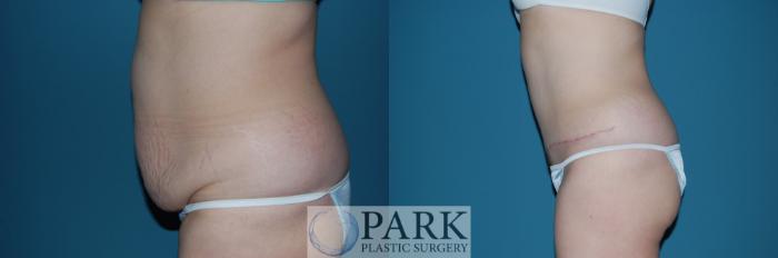 Before & After Tummy Tuck Case 38 Left Side View in Rocky Mount, NC