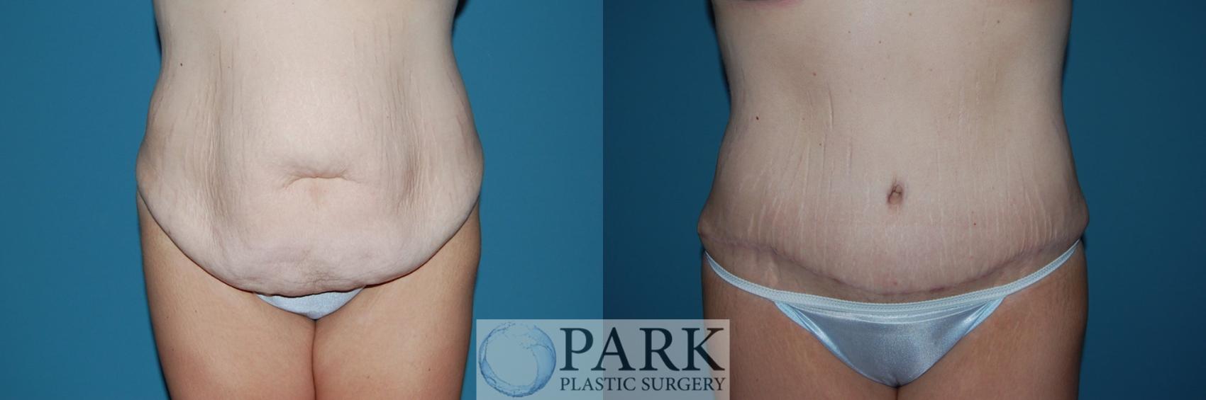 Before & After Tummy Tuck Case 39 Front View in Rocky Mount, NC
