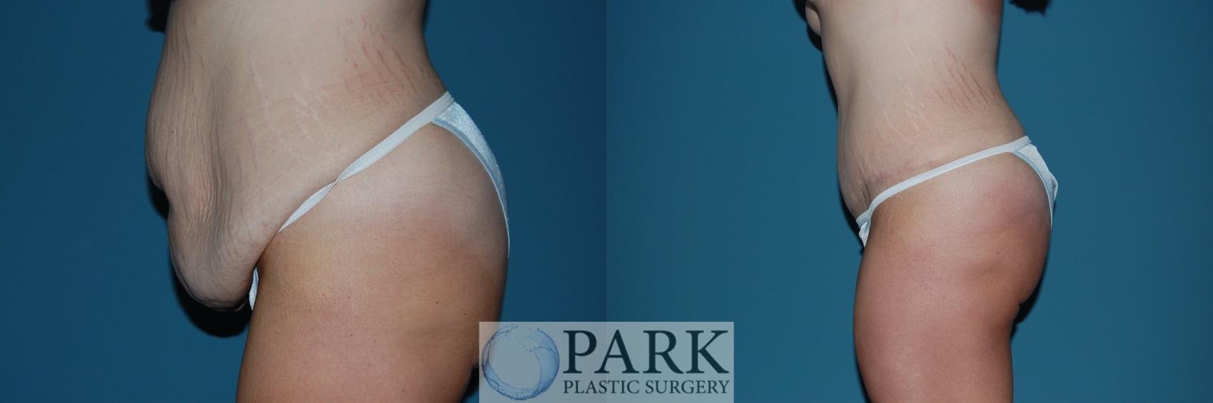 Before & After Tummy Tuck Case 39 Left Side View in Rocky Mount & Greenville, NC