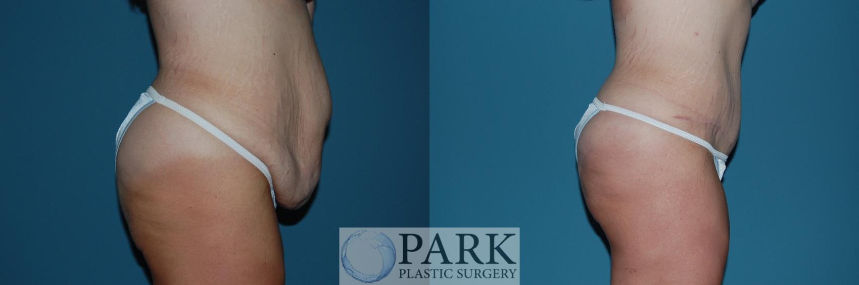 Before & After Tummy Tuck Case 39 Right Side View in Rocky Mount & Greenville, NC