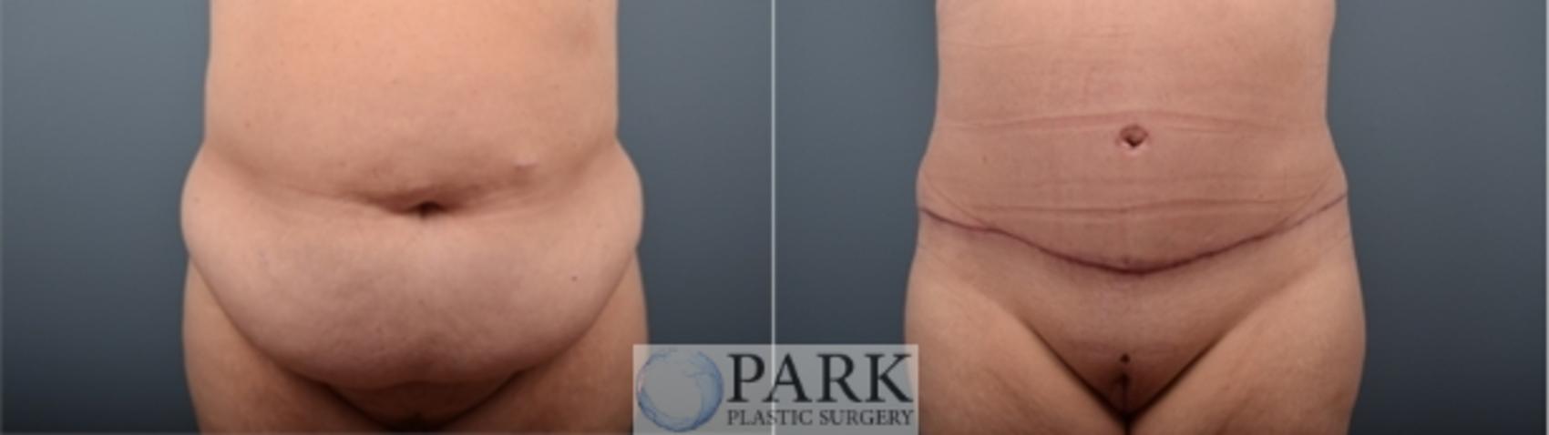Before & After Tummy Tuck Case 54 Front View in Rocky Mount, NC