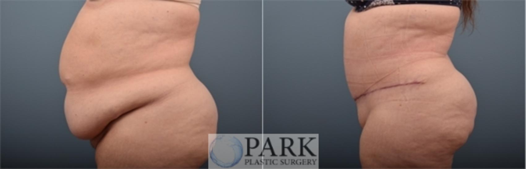 Before & After Tummy Tuck Case 54 Left Side View in Rocky Mount & Greenville, NC