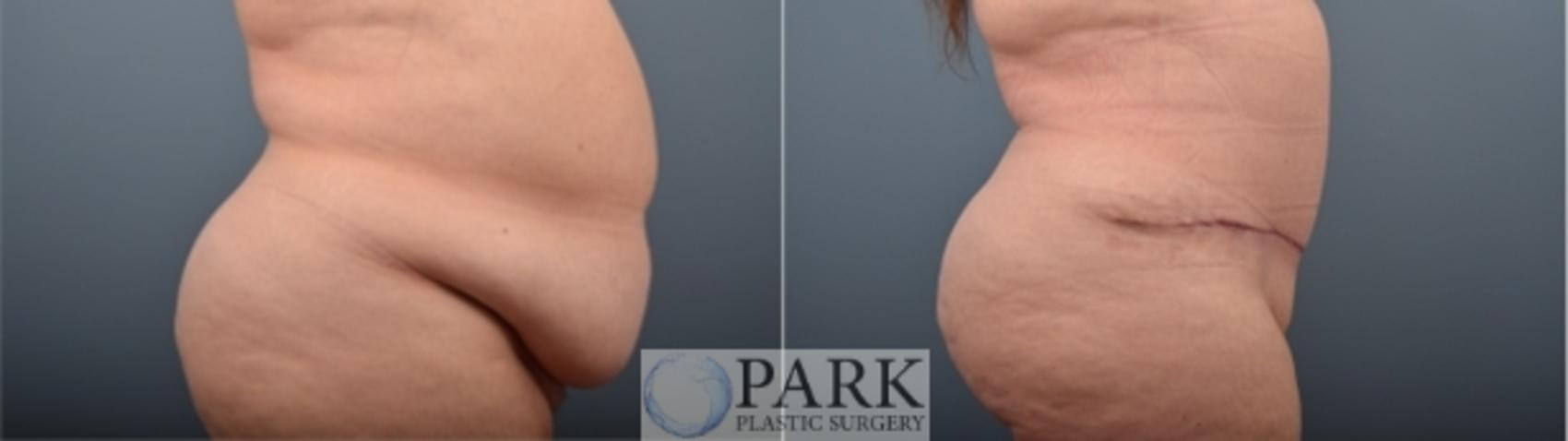 Before & After Tummy Tuck Case 54 Right Side View in Rocky Mount & Greenville, NC