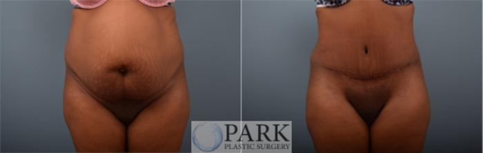 Before & After Tummy Tuck Case 56 Front View in Rocky Mount, NC