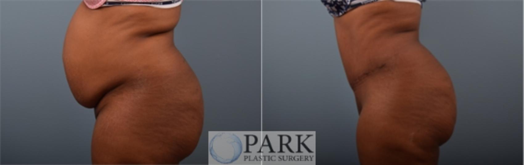 Before & After Tummy Tuck Case 56 Left Side View in Rocky Mount & Greenville, NC