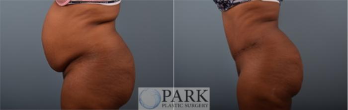 Before & After Tummy Tuck Case 56 Left Side View in Rocky Mount, NC
