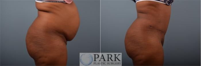 Before & After Tummy Tuck Case 56 Right Side View in Rocky Mount & Greenville, NC