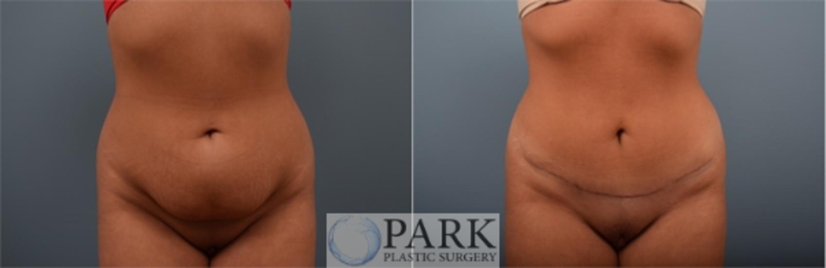 Before & After Tummy Tuck Case 57 Front View in Rocky Mount & Greenville, NC