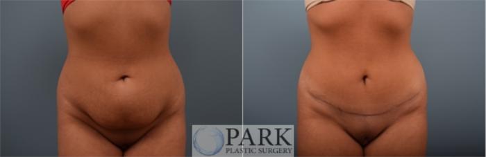 Before & After Tummy Tuck Case 57 Front View in Rocky Mount, NC