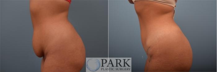 Before & After Tummy Tuck Case 57 Left Side View in Rocky Mount & Greenville, NC