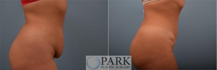 Before & After Tummy Tuck Case 57 Right Side View in Rocky Mount & Greenville, NC