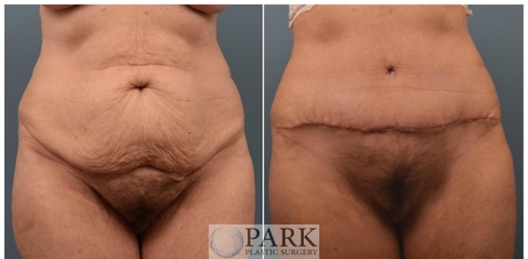 Before & After Tummy Tuck Case 60 Front View in Rocky Mount, NC