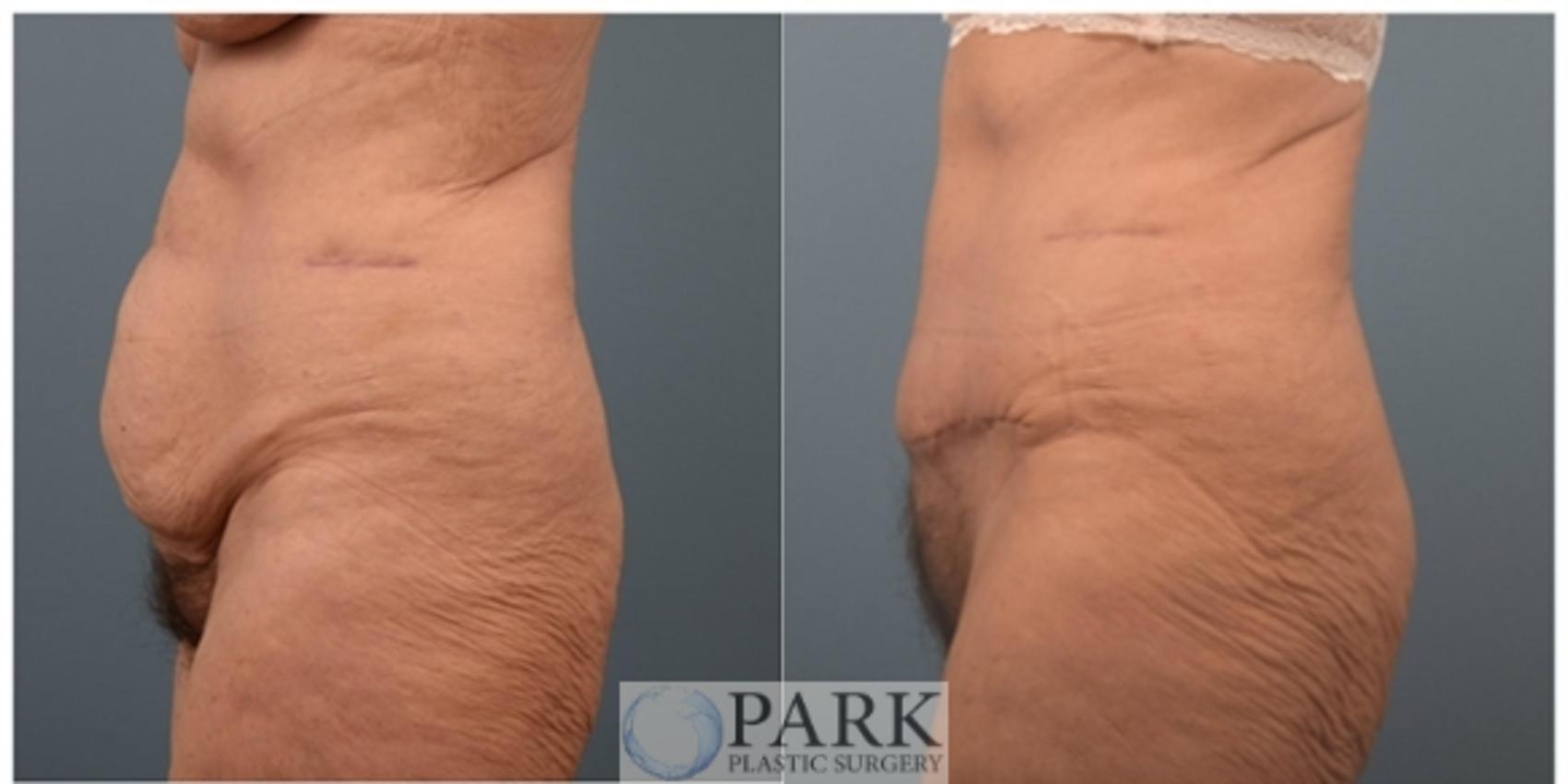 Before & After Tummy Tuck Case 60 Left Side View in Rocky Mount & Greenville, NC