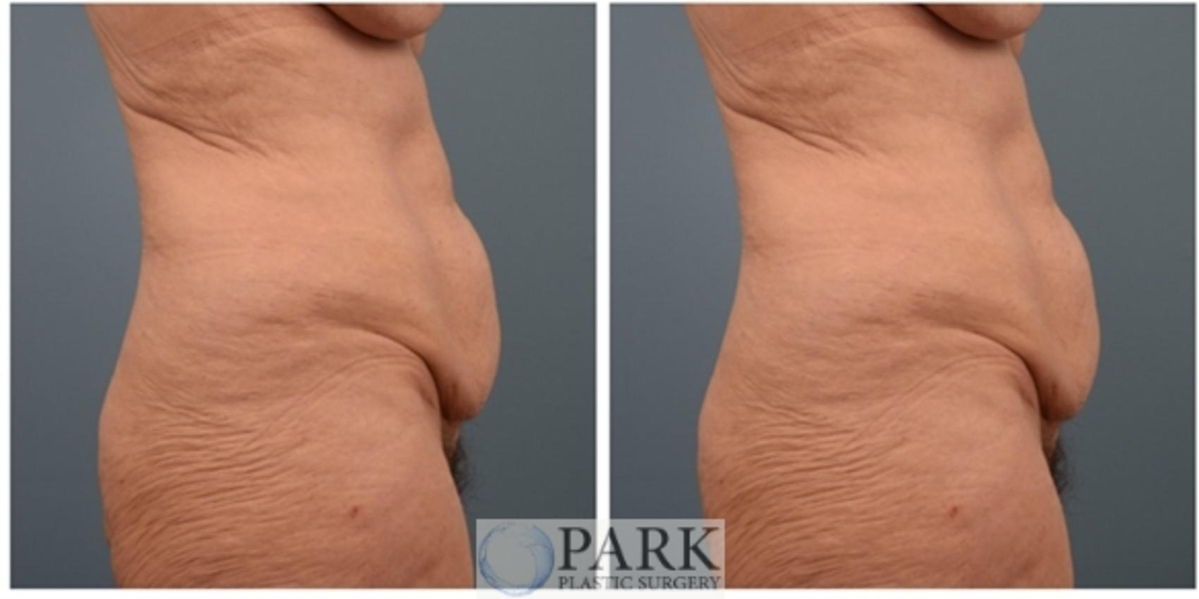 Before & After Tummy Tuck Case 60 Right Side View in Rocky Mount & Greenville, NC