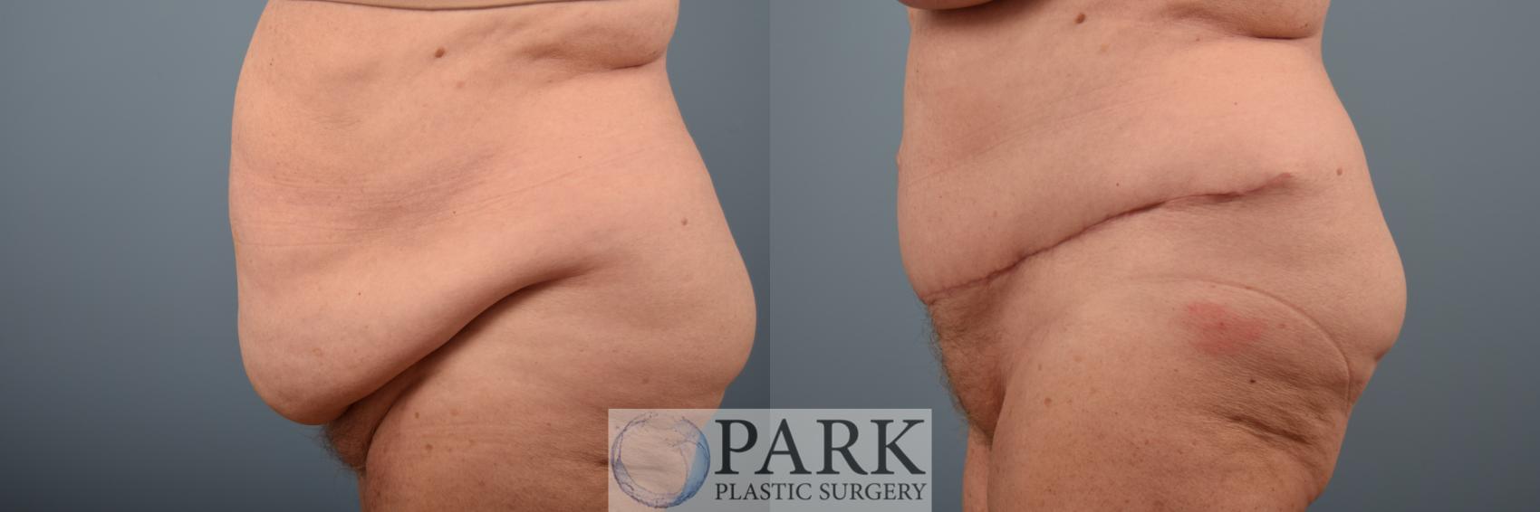 Before & After Tummy Tuck Case 66 Left Side View in Rocky Mount & Greenville, NC