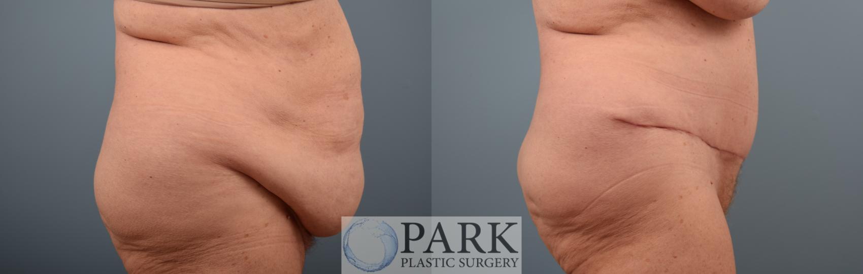 Before & After Tummy Tuck Case 66 Right Side View in Rocky Mount & Greenville, NC