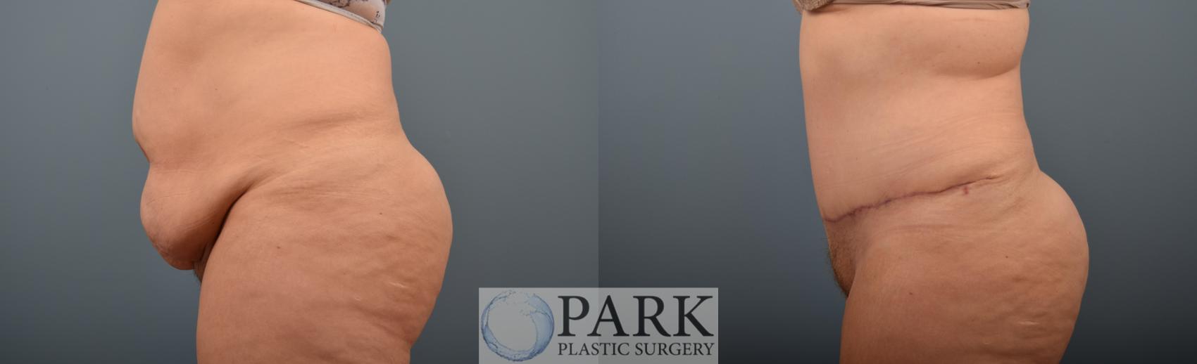Before & After Tummy Tuck Case 70 Left Side View in Rocky Mount & Greenville, NC