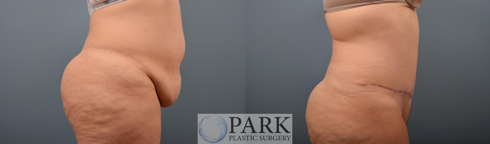 Before & After Tummy Tuck Case 70 Right Side View in Rocky Mount & Greenville, NC