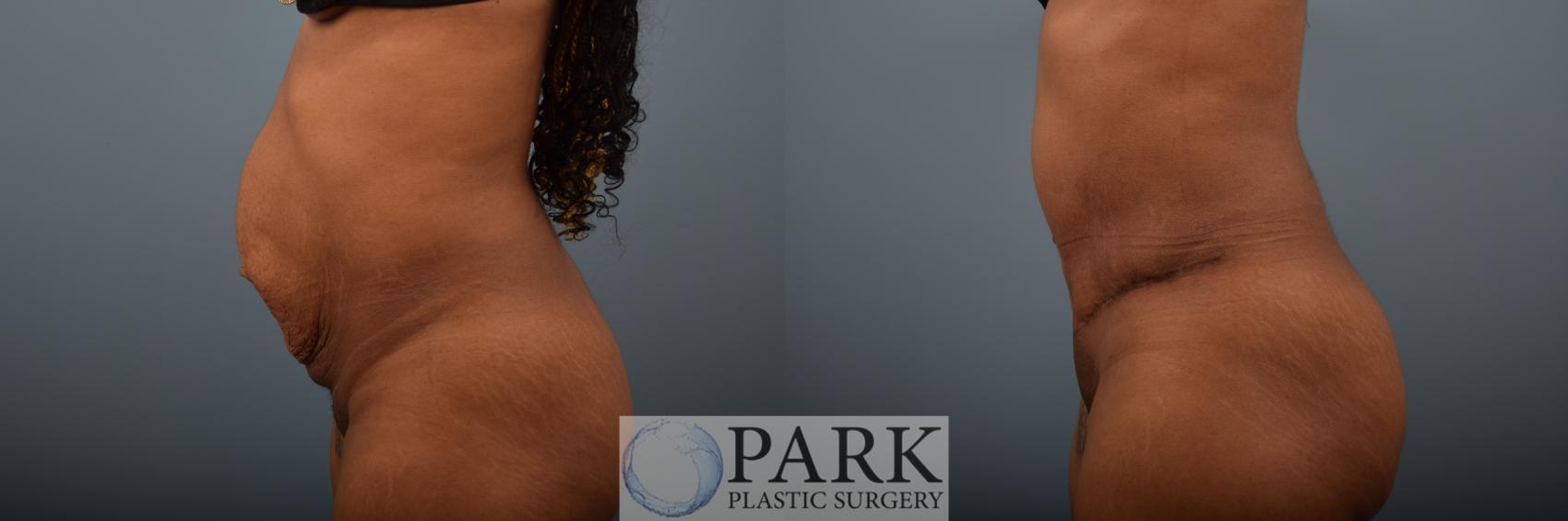 Before & After Tummy Tuck Case 82 Left Side View in Rocky Mount & Greenville, NC