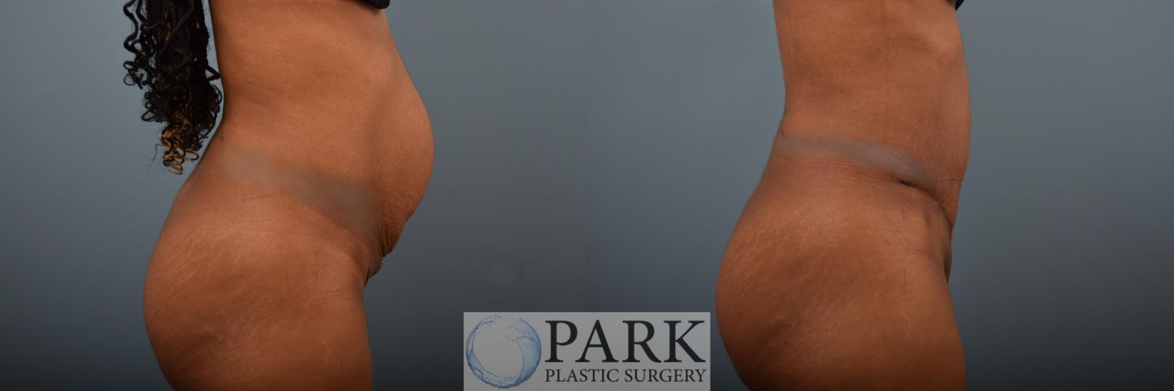 Before & After Tummy Tuck Case 82 Right Side View in Rocky Mount & Greenville, NC