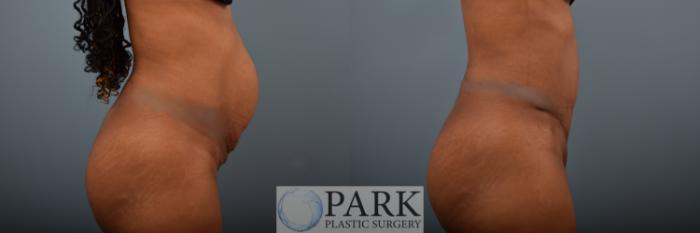 Before & After Tummy Tuck Case 82 Right Side View in Rocky Mount & Greenville, NC