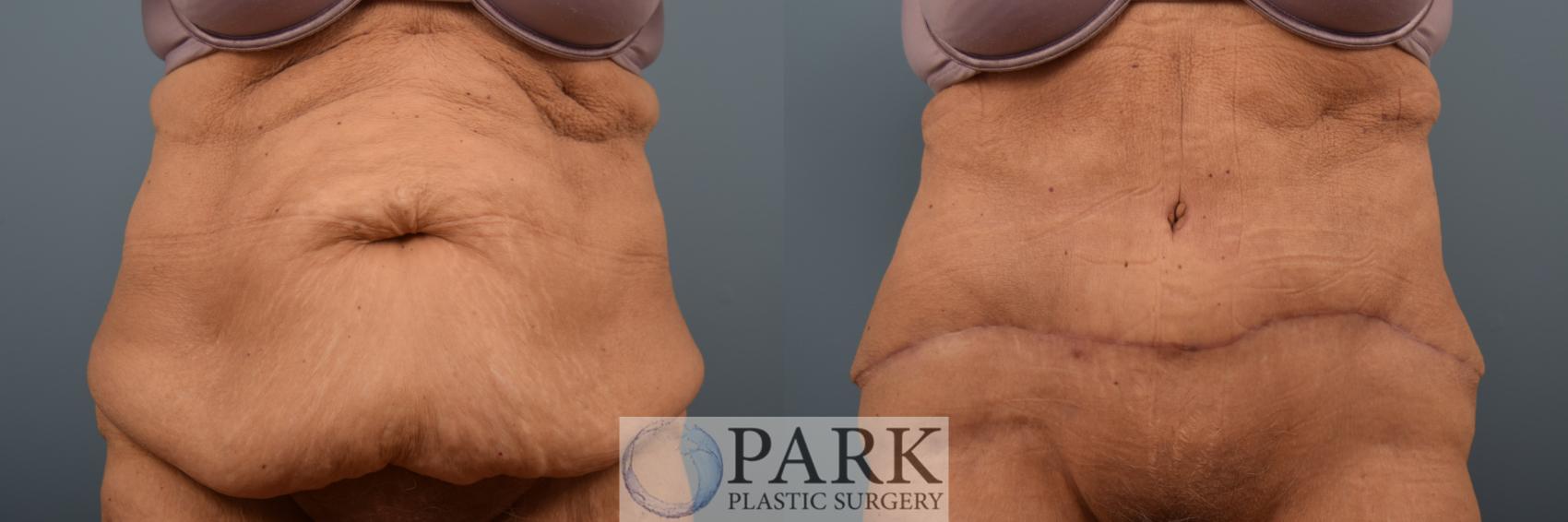 Before & After Tummy Tuck Case 89 Front View in Rocky Mount & Greenville, NC