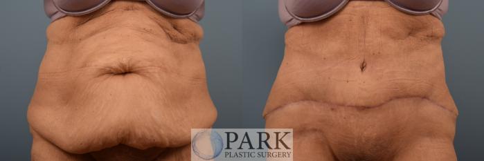 Before & After Tummy Tuck Case 89 Front View in Rocky Mount & Greenville, NC