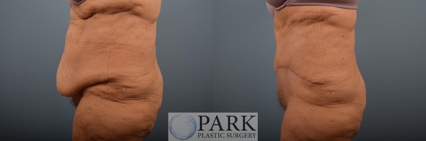 Before & After Tummy Tuck Case 89 Left Side View in Rocky Mount & Greenville, NC