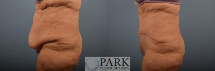 Before & After Tummy Tuck Case 89 Left Side View in Rocky Mount & Greenville, NC