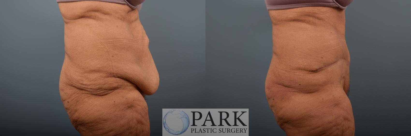 Before & After Tummy Tuck Case 89 Right Side View in Rocky Mount & Greenville, NC