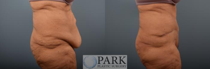 Before & After Tummy Tuck Case 89 Right Side View in Rocky Mount & Greenville, NC